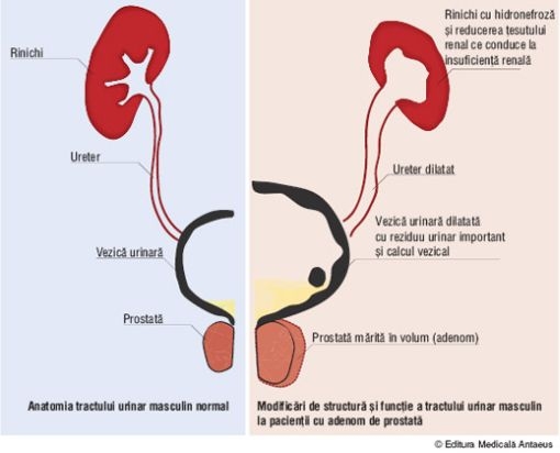 Afectiuni ale prostatei tratament cu argila